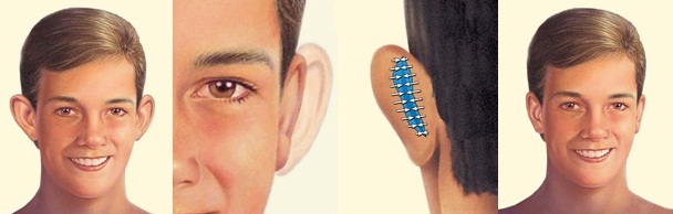 Ear Surgery Medford